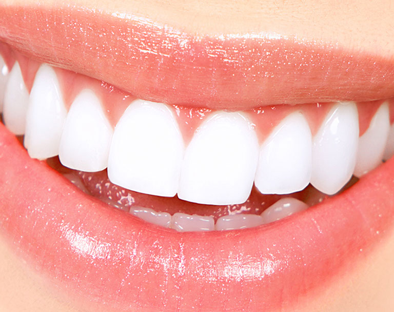 teeth_whitening_newcastle