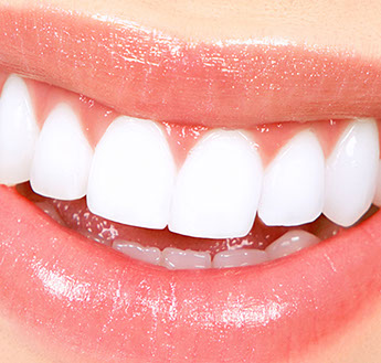 teeth_whitening_newcastle